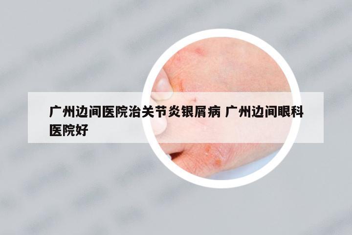 廣州邊間醫(yī)院治關(guān)節(jié)炎銀屑病 廣州邊間眼科醫(yī)院好