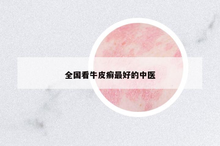 全國看牛皮癬最好的中醫(yī)