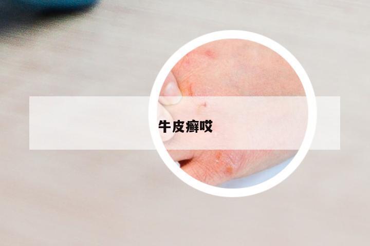 牛皮癬哎