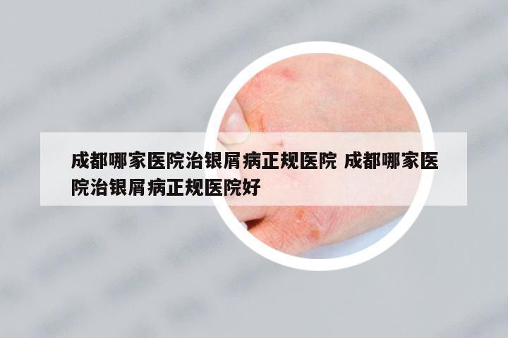 成都哪家醫(yī)院治銀屑病正規(guī)醫(yī)院 成都哪家醫(yī)院治銀屑病正規(guī)醫(yī)院好