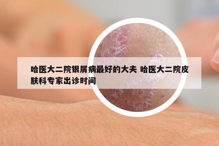 哈醫(yī)大二院銀屑病最好的大夫 哈醫(yī)大二院皮膚科專家出診時間