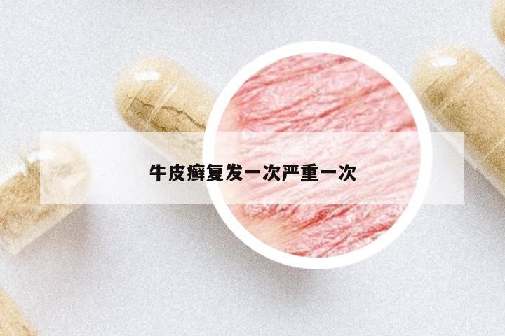 牛皮癬復(fù)發(fā)一次嚴(yán)重一次