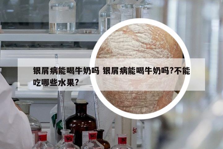 銀屑病能喝牛奶嗎 銀屑病能喝牛奶嗎?不能吃哪些水果?