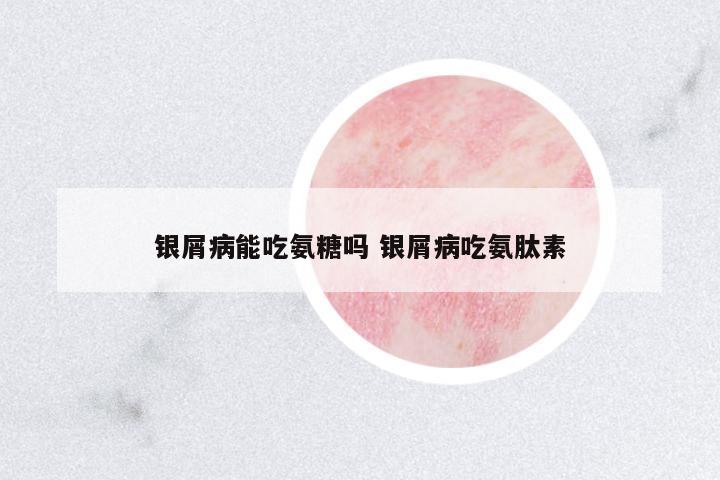 銀屑病能吃氨糖嗎 銀屑病吃氨肽素
