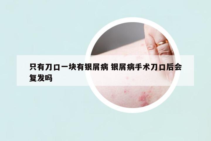 只有刀口一塊有銀屑病 銀屑病手術(shù)刀口后會(huì)復(fù)發(fā)嗎