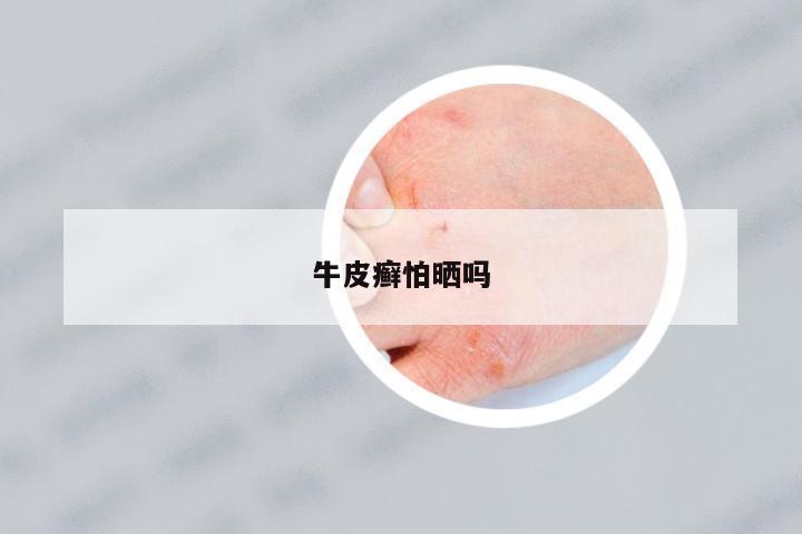 牛皮癬怕曬嗎