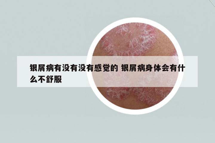 銀屑病有沒有沒有感覺的 銀屑病身體會有什么不舒服