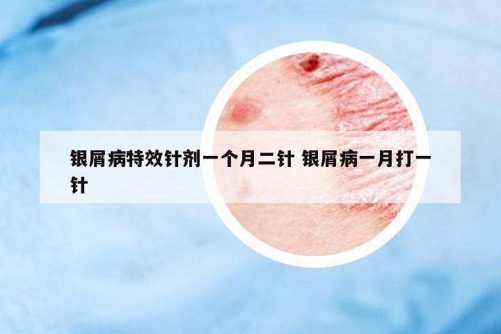銀屑病特效針劑一個(gè)月二針 銀屑病一月打一針