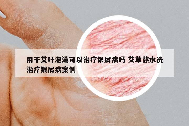 用干艾葉泡澡可以治療銀屑病嗎 艾草熬水洗治療銀屑病案例