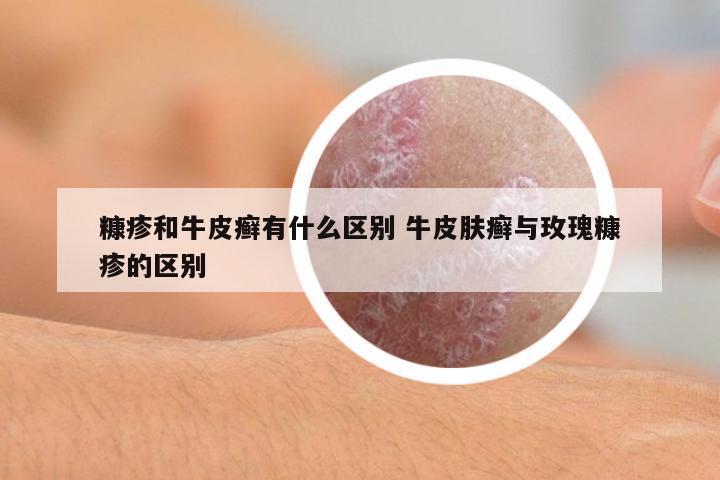 糠疹和牛皮癬有什么區(qū)別 牛皮膚癬與玫瑰糠疹的區(qū)別