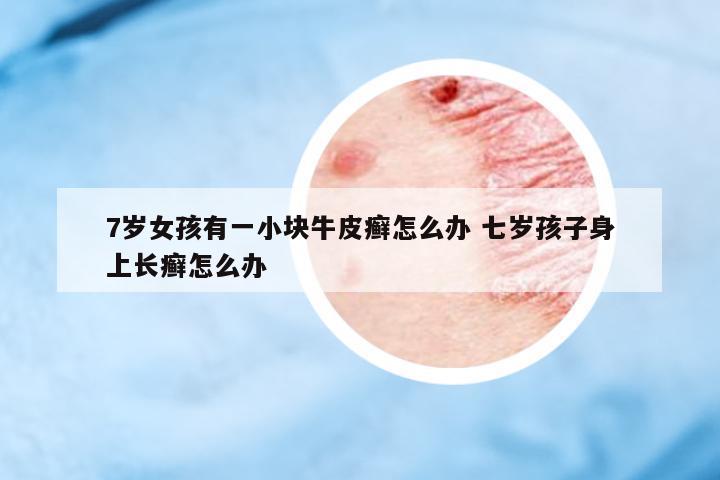 7歲女孩有一小塊牛皮癬怎么辦 七歲孩子身上長(zhǎng)癬怎么辦