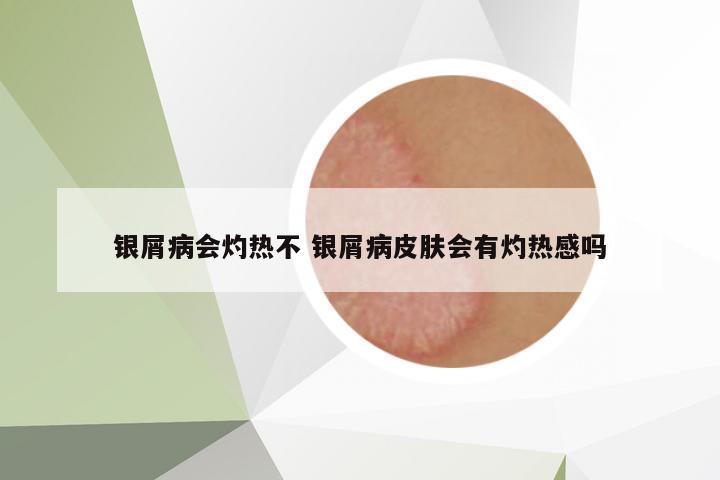 銀屑病會灼熱不 銀屑病皮膚會有灼熱感嗎