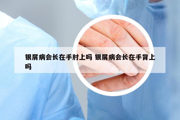 銀屑病會(huì)長(zhǎng)在手肘上嗎 銀屑病會(huì)長(zhǎng)在手背上嗎