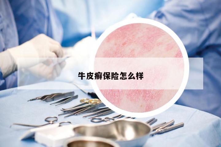 牛皮癬保險怎么樣