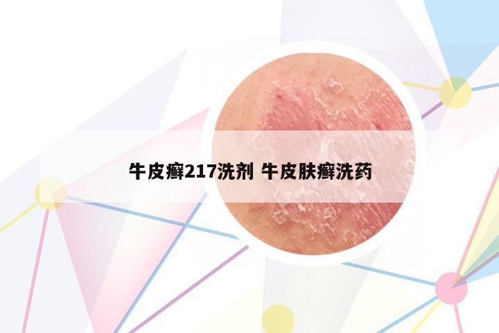 牛皮癬217洗劑 牛皮膚癬洗藥