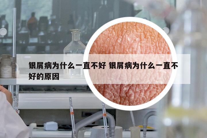 銀屑病為什么一直不好 銀屑病為什么一直不好的原因