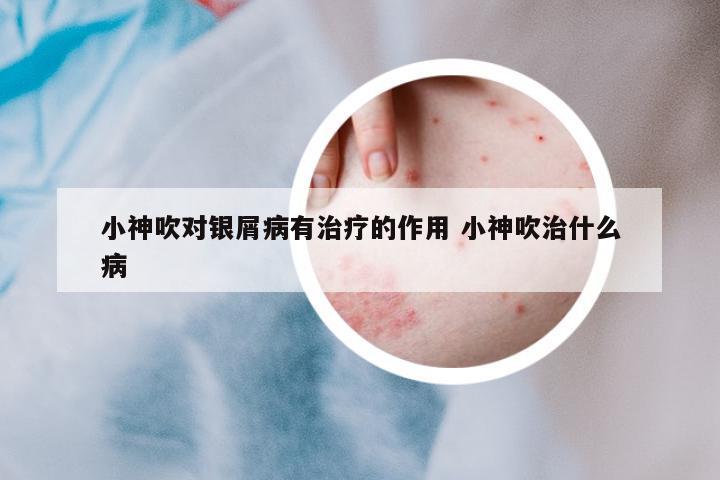 小神吹對(duì)銀屑病有治療的作用 小神吹治什么病