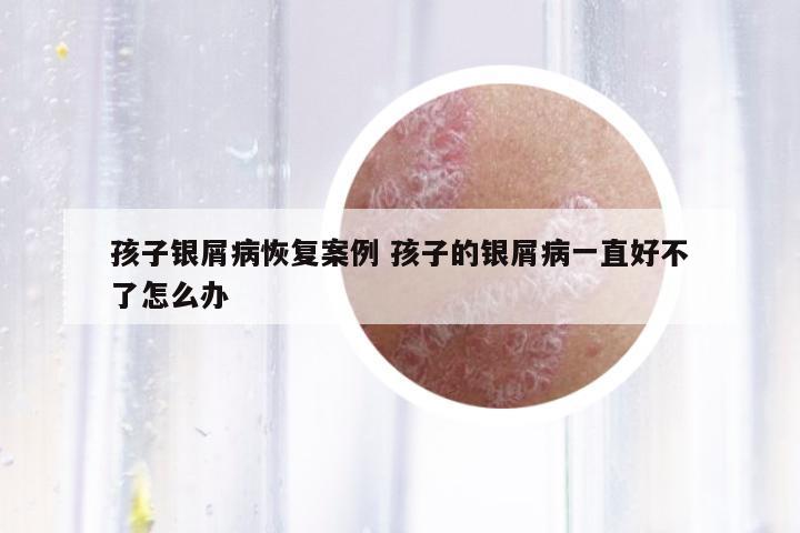 孩子銀屑病恢復(fù)案例 孩子的銀屑病一直好不了怎么辦