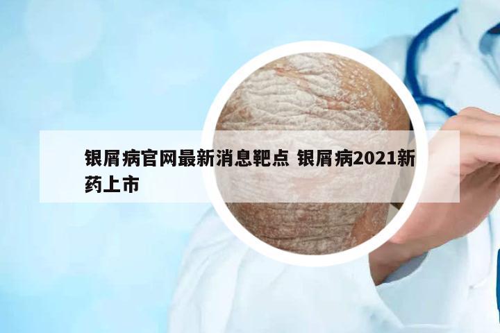 銀屑病官網(wǎng)最新消息靶點 銀屑病2021新藥上市