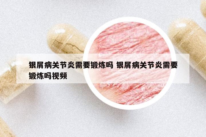 銀屑病關(guān)節(jié)炎需要鍛煉嗎 銀屑病關(guān)節(jié)炎需要鍛煉嗎視頻