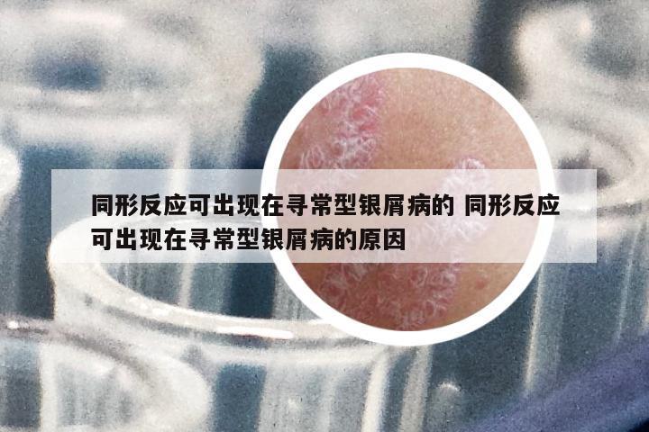 同形反應(yīng)可出現(xiàn)在尋常型銀屑病的 同形反應(yīng)可出現(xiàn)在尋常型銀屑病的原因