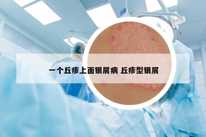 一個(gè)丘疹上面銀屑病 丘疹型銀屑