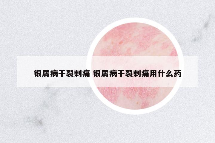 銀屑病干裂刺痛 銀屑病干裂刺痛用什么藥