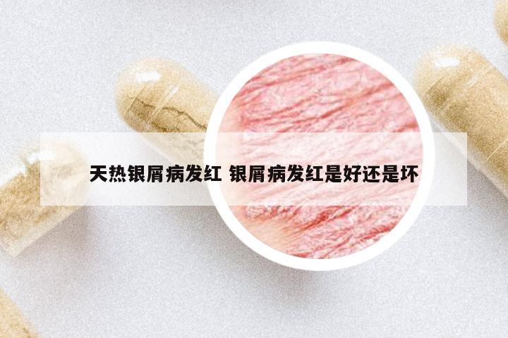 天熱銀屑病發(fā)紅 銀屑病發(fā)紅是好還是壞
