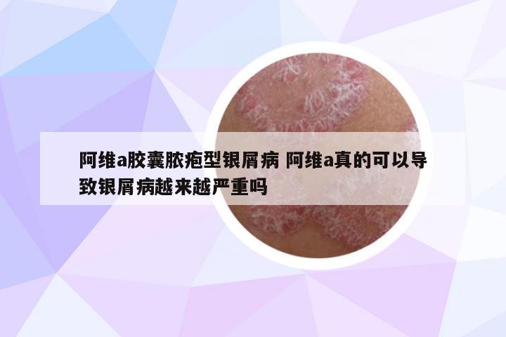 阿維a膠囊膿皰型銀屑病 阿維a真的可以導(dǎo)致銀屑病越來越嚴(yán)重嗎