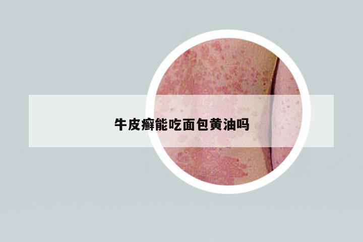 牛皮癬能吃面包黃油嗎