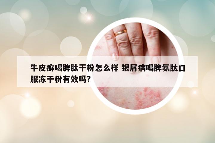 牛皮癬喝脾肽干粉怎么樣 銀屑病喝脾氨肽口服凍干粉有效嗎?