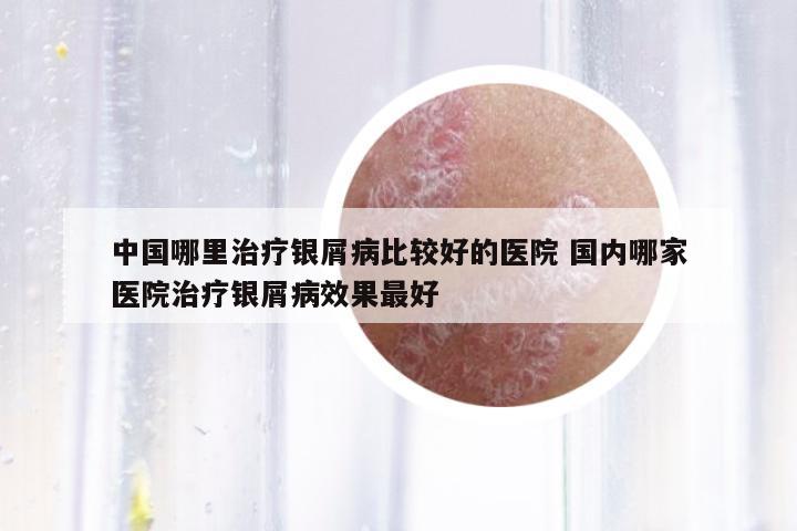 中國哪里治療銀屑病比較好的醫(yī)院 國內(nèi)哪家醫(yī)院治療銀屑病效果最好
