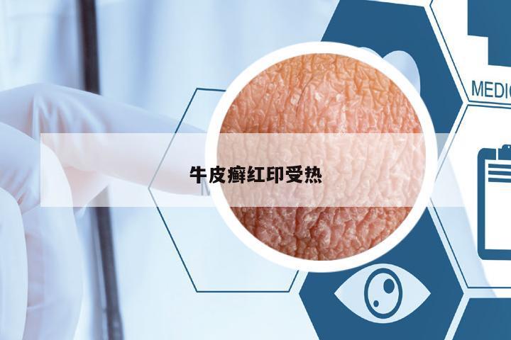 牛皮癬紅印受熱