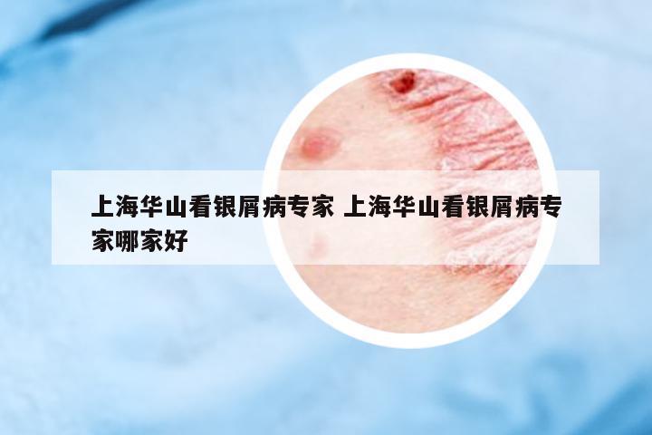 上海華山看銀屑病專(zhuān)家 上海華山看銀屑病專(zhuān)家哪家好