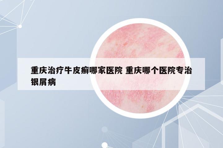 重慶治療牛皮癬哪家醫(yī)院 重慶哪個(gè)醫(yī)院專治銀屑病