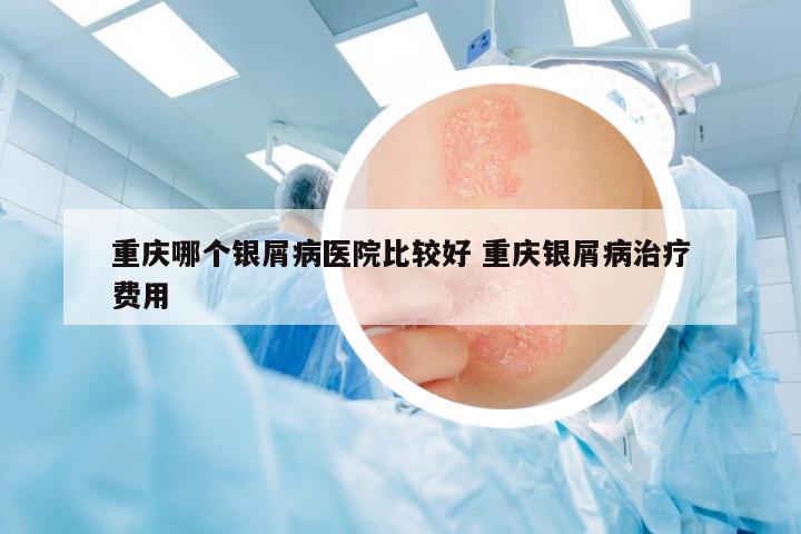 重慶哪個銀屑病醫(yī)院比較好 重慶銀屑病治療費用
