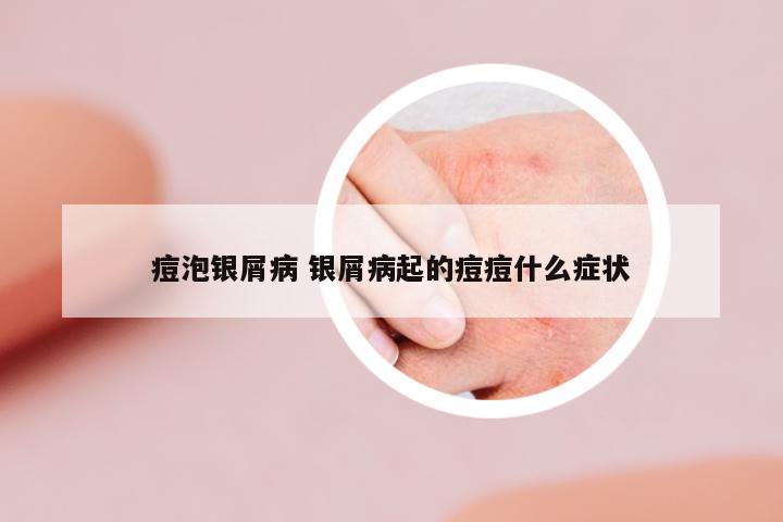 痘泡銀屑病 銀屑病起的痘痘什么癥狀