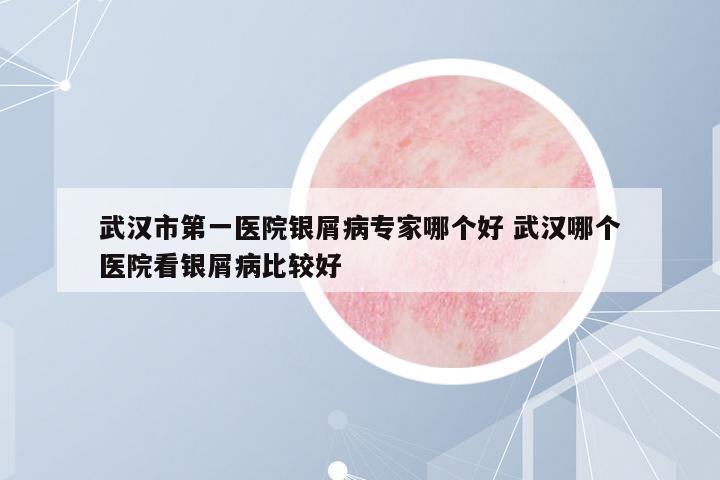 武漢市第一醫(yī)院銀屑病專家哪個(gè)好 武漢哪個(gè)醫(yī)院看銀屑病比較好