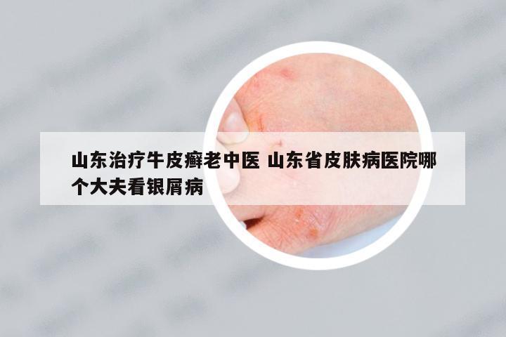 山東治療牛皮癬老中醫(yī) 山東省皮膚病醫(yī)院哪個大夫看銀屑病