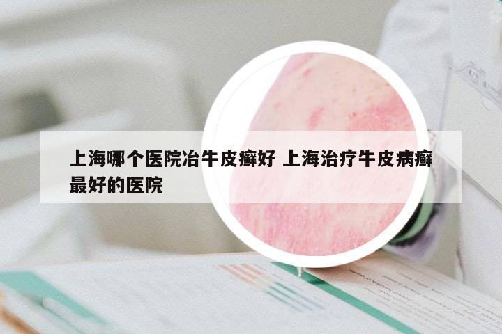 上海哪個(gè)醫(yī)院冶牛皮癬好 上海治療牛皮病癬最好的醫(yī)院