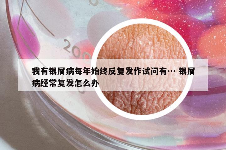 我有銀屑病每年始終反復(fù)發(fā)作試問(wèn)有… 銀屑病經(jīng)常復(fù)發(fā)怎么辦