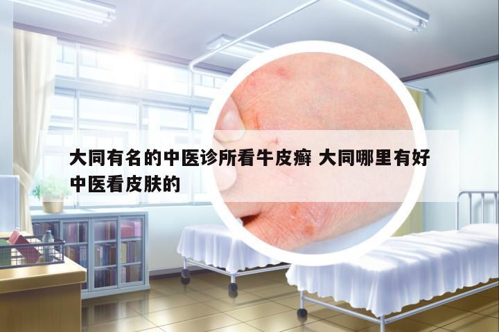 大同有名的中醫(yī)診所看牛皮癬 大同哪里有好中醫(yī)看皮膚的