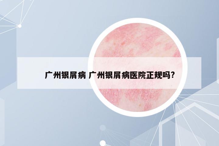 廣州銀屑病 廣州銀屑病醫(yī)院正規(guī)嗎?