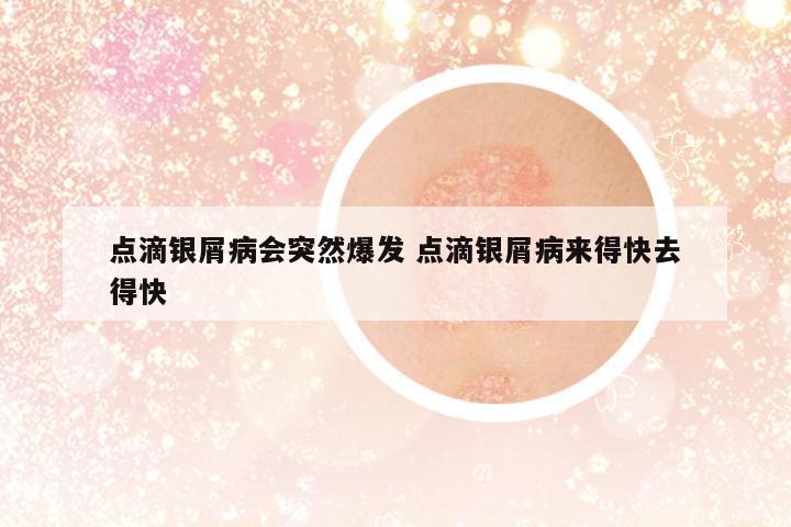 點(diǎn)滴銀屑病會(huì)突然爆發(fā) 點(diǎn)滴銀屑病來得快去得快