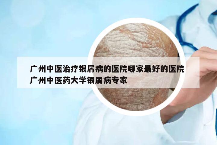 廣州中醫(yī)治療銀屑病的醫(yī)院哪家最好的醫(yī)院 廣州中醫(yī)藥大學(xué)銀屑病專(zhuān)家