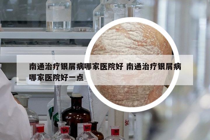 南通治療銀屑病哪家醫(yī)院好 南通治療銀屑病哪家醫(yī)院好一點