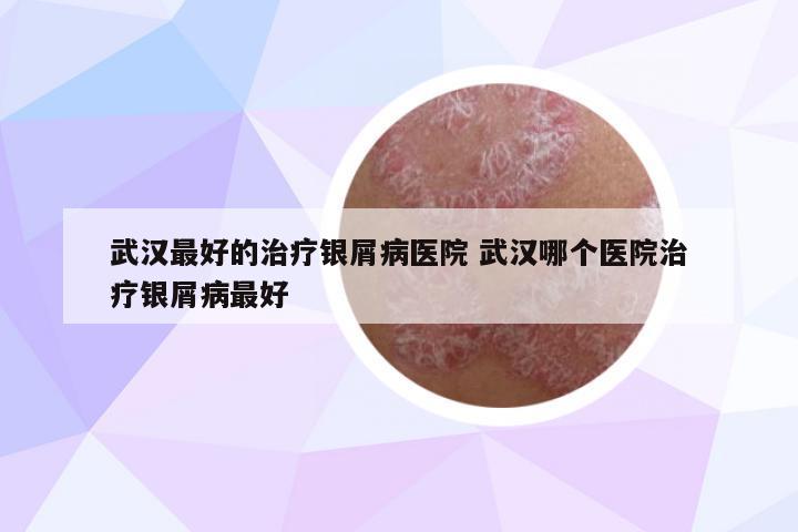 武漢最好的治療銀屑病醫(yī)院 武漢哪個(gè)醫(yī)院治療銀屑病最好