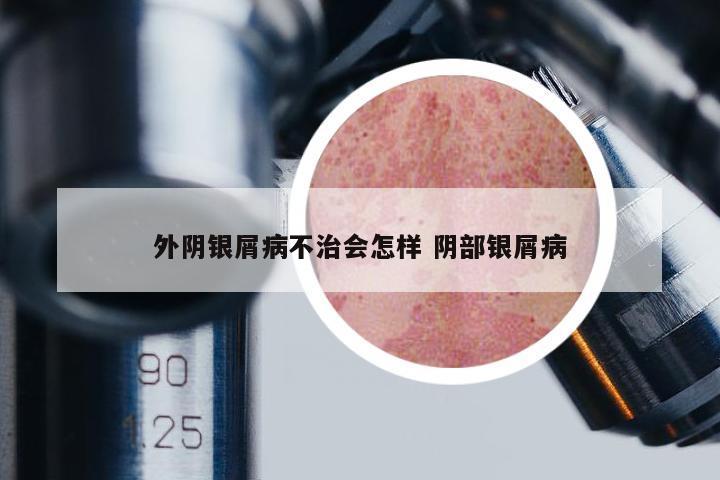 外陰銀屑病不治會(huì)怎樣 陰部銀屑病