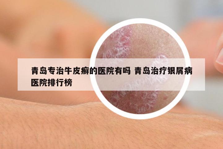 青島專治牛皮癬的醫(yī)院有嗎 青島治療銀屑病醫(yī)院排行榜