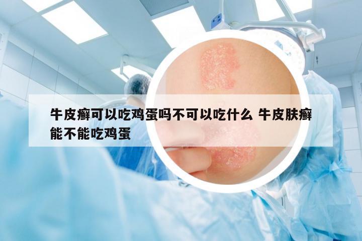 牛皮癬可以吃雞蛋嗎不可以吃什么 牛皮膚癬能不能吃雞蛋